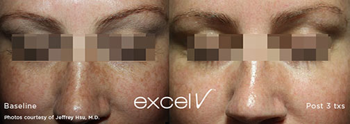 excel v - Pigmented Lesions